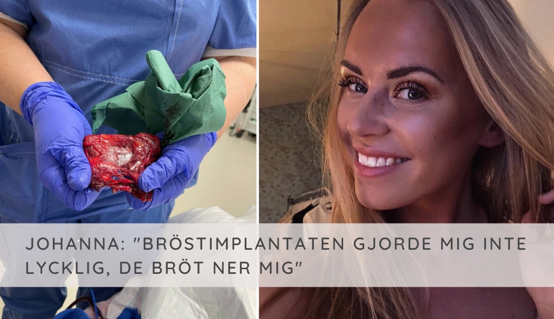 Johanna gjorde en bröstförstoring: ”Blev bara sjukare och sjukare”