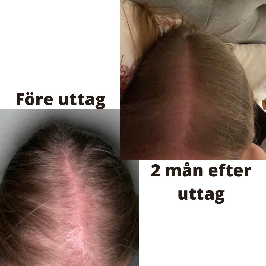 Håravfall före och efter