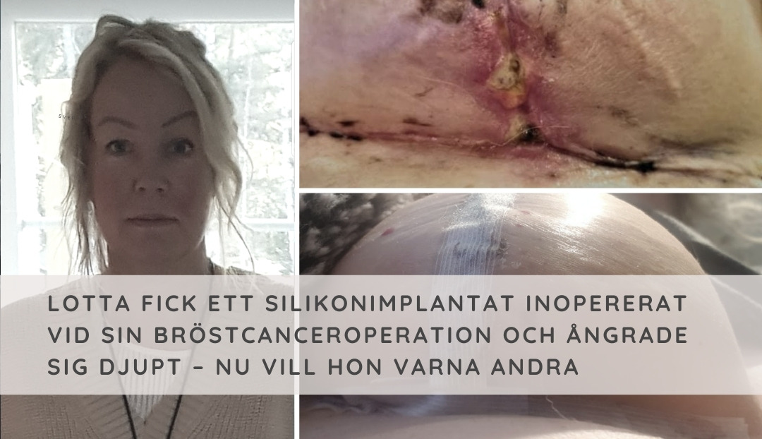 Lotta fick ett silikonimplantat vid sin bröstcanceroperation – nu vill hon varna andra för komplikationer