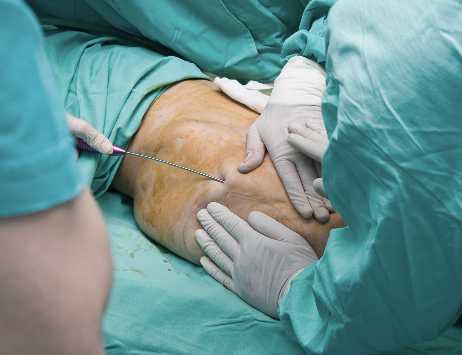 fettransplantation bröst
